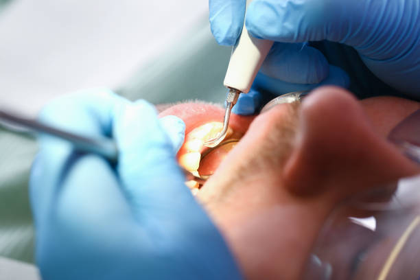 Best Emergency Wisdom Tooth Extraction in Rosedale, MS